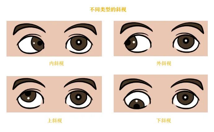 斜视类型.jpg