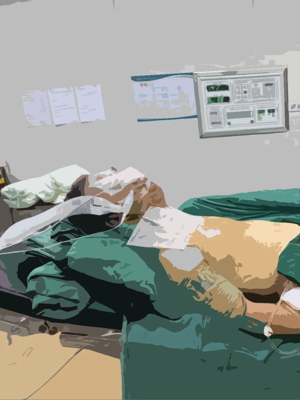 强直患者遭遇颈椎骨折 多学科协作助其康复