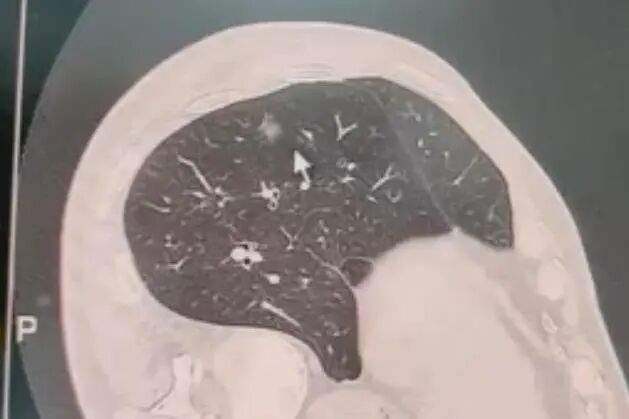 CT引导下微弹簧圈穿刺定位技术，让肺小结节无处遁形